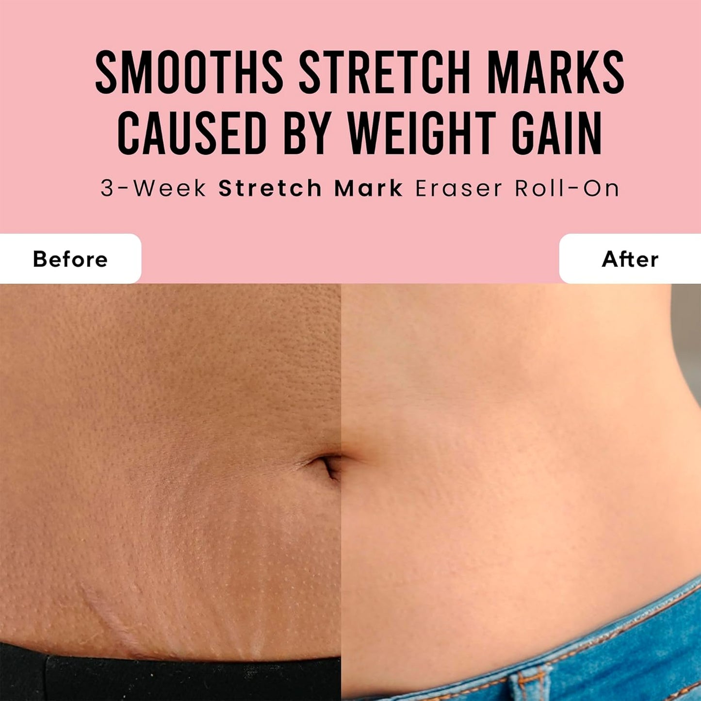Cos-IQ Stretch Marks Removal Roll-On Serum with Striover | Scar Removal | Uneven Skin Tone | All Skin Types | 40ml