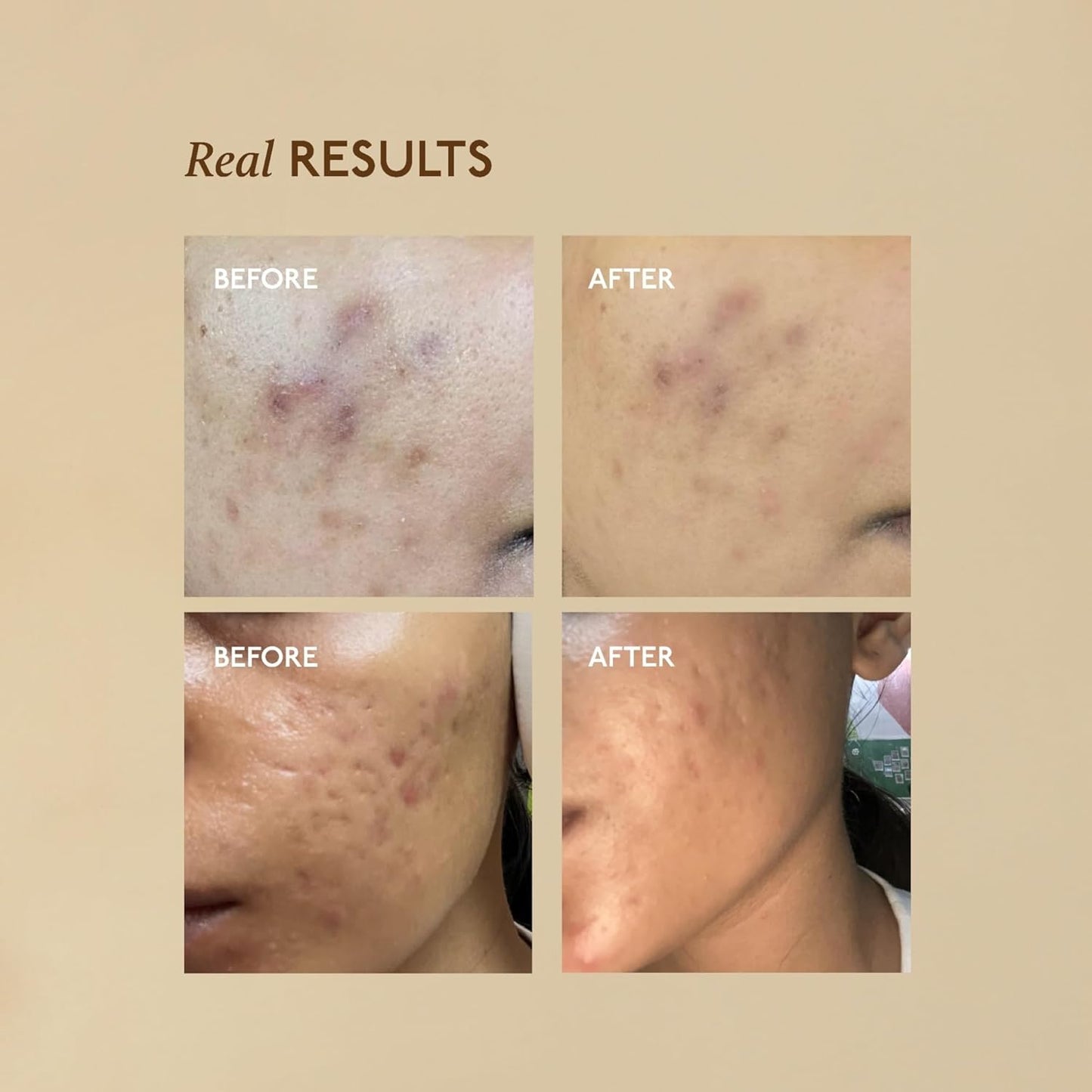 Asaya Advanced Spot Pigmentation Face Serum | Reduces Dark Spots, Melasma, Acne Marks & Hyperpigmentation | MelaMe™ Complex, Niacinamide & Alpha Arbutin | Lightweight & Fast Absorbing | For Men & Women | Oily, Dry & Sensitive Skin - 30ml