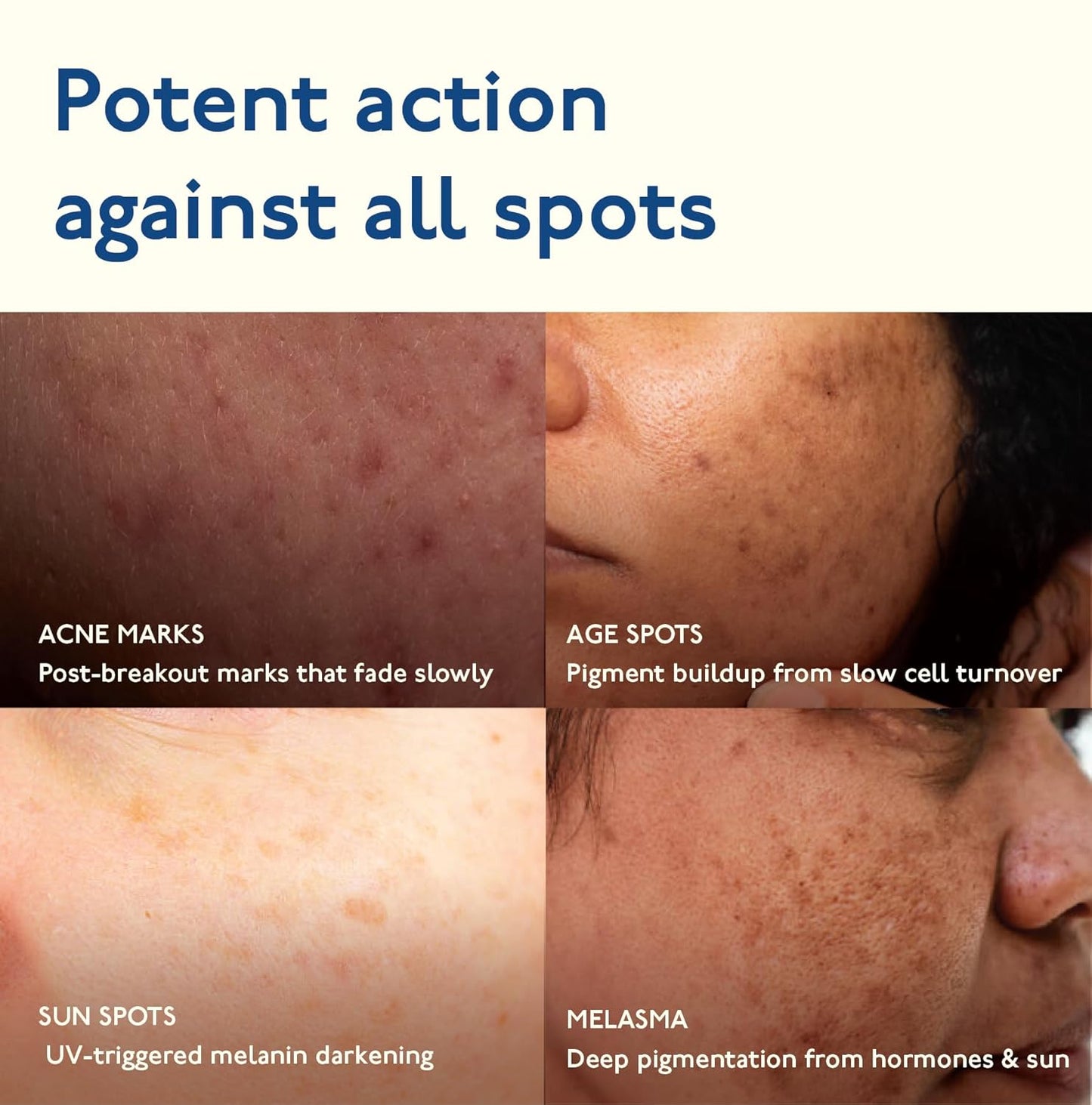 Asaya Advanced Dark Spot Targeting Gel | Reduces Pigmentation, Post-Inflammatory Hyperpigmentation, Acne Marks & Scars | MelaMe™ Complex, Spicules & Alpha Arbutin | for Oily, Sensitive & Dry Skin - 15 g