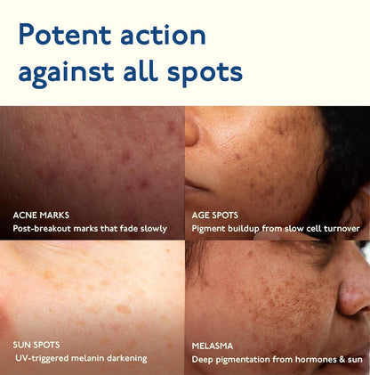 Asaya Advanced Dark Spot Targeting Gel | Reduces Pigmentation, Post-Inflammatory Hyperpigmentation, Acne Marks & Scars | MelaMe™ Complex, Spicules & Alpha Arbutin | for Oily, Sensitive & Dry Skin - 15 g